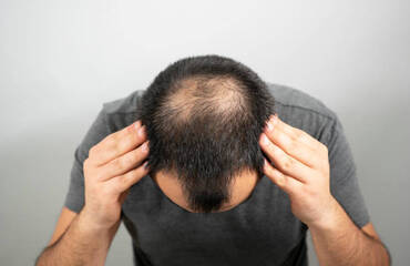 How Long Do Hair Transplants Last? Everything You Need to Know
