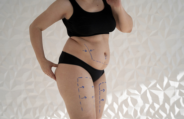 What is Thigh Lift Operation?