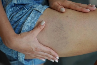 Varicose Veins 101: Causes, Symptoms, and Treatment Options