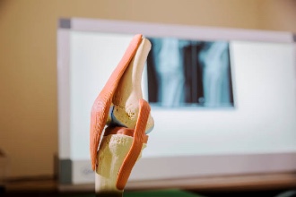 Knee Implants: A Simple Guide