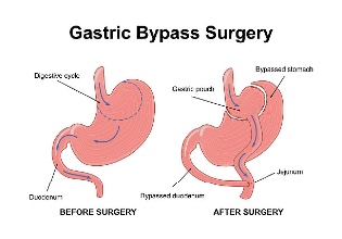 Do Hair Transplants Look Natural? Real Facts vs. Myths