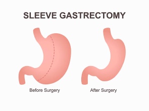 Gastric Sleeve Surgery: Safe, Effective Weight Loss