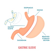 Gastric Sleeve Surgery: Safe, Effective Weight Loss