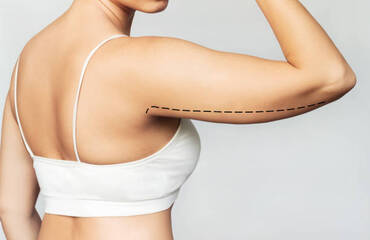 Arm Lift Surgery (Brachioplasty)