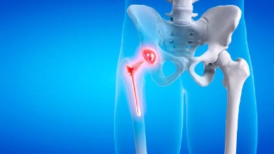 Hip Replacement Surgery: Regain Your Mobility