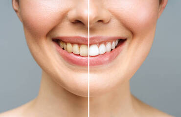 Teeth Whitening: Reveal a Brighter Smile